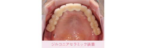 症例：ブリッジにしている上の歯が全体的にぐらついて噛みにくい。
