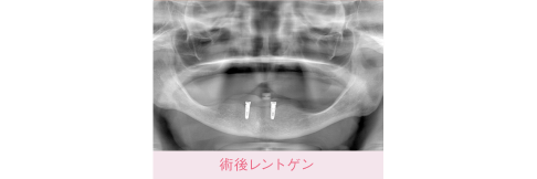 症例：長年入れ歯をしているが下の入れ歯ががたついて噛めない。