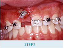 症例：両隣の歯を削りブリッジにしてかぶせる必要があると言われた。