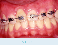 症例：両隣の歯を削りブリッジにしてかぶせる必要があると言われた。